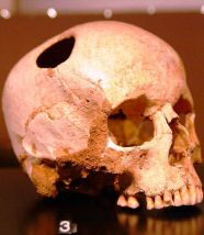 Trepanation